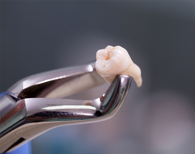 Dr Ashwin Kassan, Wisdom Teeth Removal, Maxillo-facial and Oral Surgeon