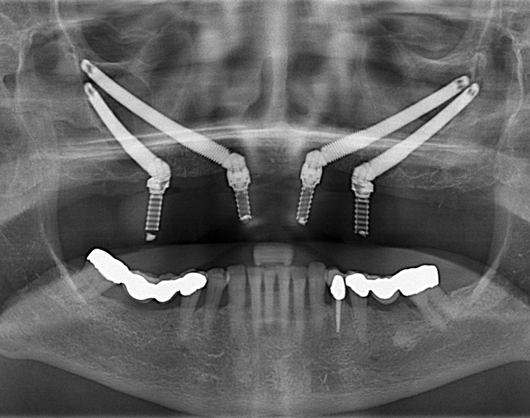 Dr Ashwin Kassan, Dental Implants, Maxillo-facial and Oral Surgeon